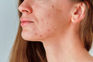 How Hormones Affect Acne